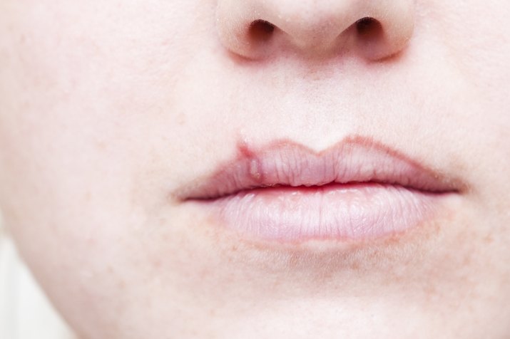 Herpes Cold Sore on Mouth